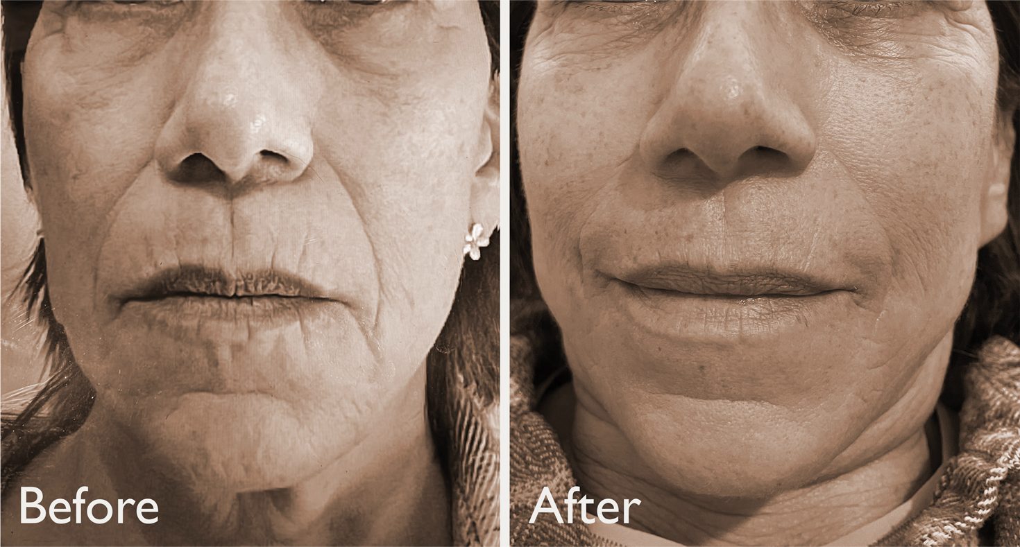 endermologie-aspen-before-after-compressed